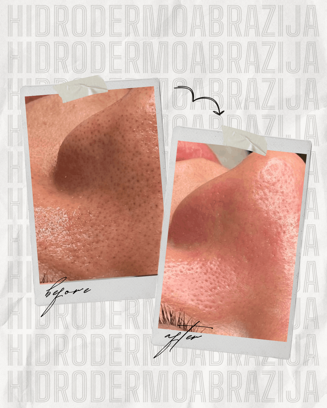 Hidro Dermo Abrazija