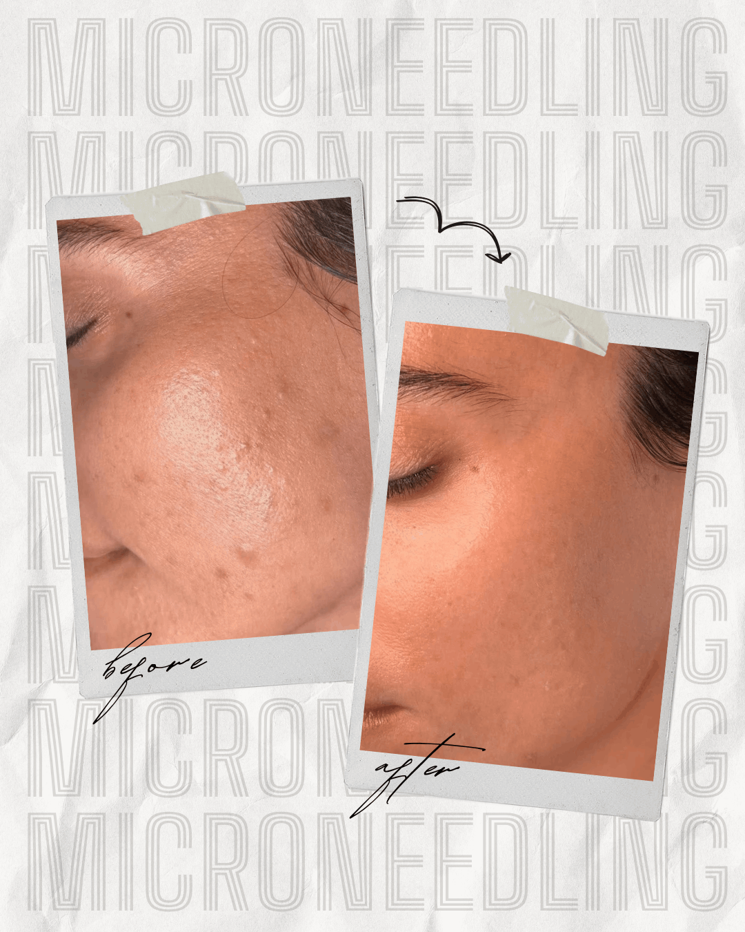 Microneedling tretman